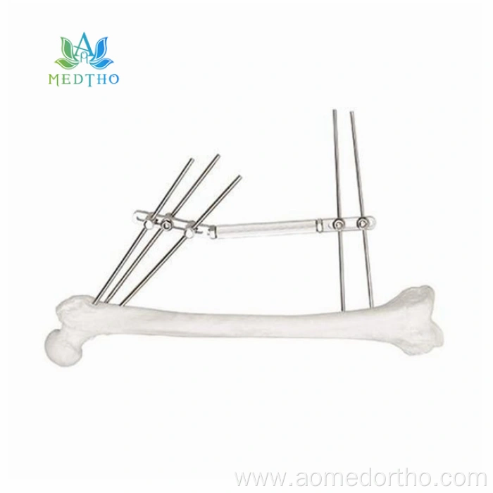 external fracture